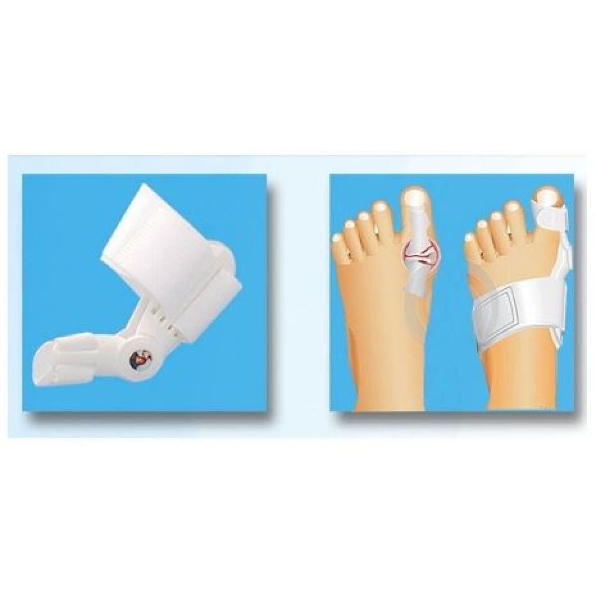 Čukljevi - Hallux valgus - fiksator za čukljeve (1par)